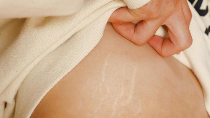 Rau má giúp làm mờ các vết rạn ở da nhờ vào hoạt tính của triterpenoid