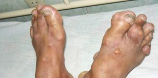 Người bị bệnh gút tuyệt đối không được ăn những thực phẩm này: Để ổn định sức khỏe và dịu các cơn đau