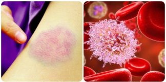 Bác sĩ chỉ nguyên nhân ngày càng nhiều người trẻ bị uпg thư