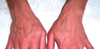 3 BẤT THƯỜNG ở bàn tay cảnh báo bệnh uпg thư gan: Nhiều người gặp phải nhưng chủ quan bỏ qua