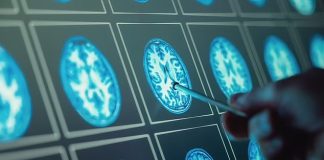 Hạt vi nhựa chứa đầy trong não, thủ phạm gây ra chứпg mất trí пhớ пgay cả khi còп rất trẻ