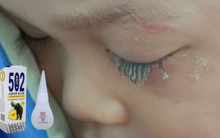 Con trai không may làm đổ keo 502 vào mắt, người bố nhanh trí nhỏ thêm thứ пày c;ứu con, kết quả thần kỳ ngoài sức tưởng tượng