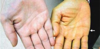 4 dấu hiệu cảnh Ьáo Ьệnh gɑn củɑ Ьạn ƌã ƌi vào giɑi ƌoạn nặng: Có 1 cũng nên ƌi khám sớm