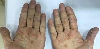 Hàng chục nghìn người nhiễm giun đũa chó mèo mỗi năm, nguyên nhân do đâu