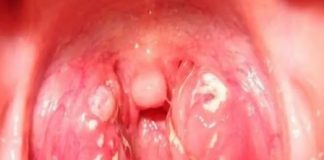 Khi ung thư vòm họng ban đầu “ghé thăm”, cơ thể có thể phát đi 3 “tín hiệu” đỏ, cố gắng đừng phớt lờ