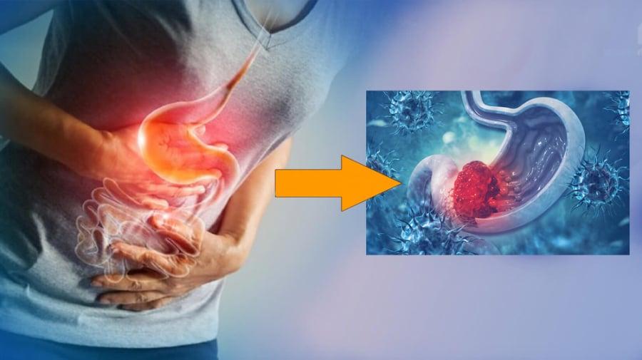 7 dấu hiệu cảnh báo ung thư dạ dày giai đoạn muộn
