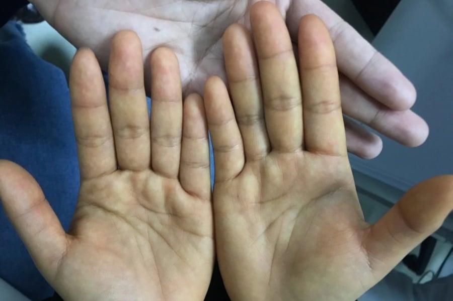 Sưng tay chân, hay còn gọi là phù nề, là một triệu chứng phổ biến nhưng đôi khi dễ bị bỏ qua.