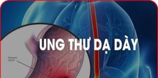 7 dấu hiệu u-ng thư dạ dày giai đoạn sớm, ai cũng cần biết kẻo di căn xa