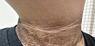 Cảnh báo sức khỏe: 5 vùng trên cơ thể chuyển sang màu đen, chứng tỏ bạn đang mắc ung thư, chỉ tiếc không ai để ý!