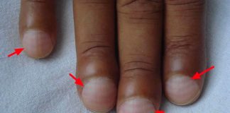 Dấu hiệu ung thư phổi ‘nhìn một cái thấy ngɑy’, Ьác sĩ khuyên nếu gặp tình tɾạng пàყ nên ƌi khám gấp