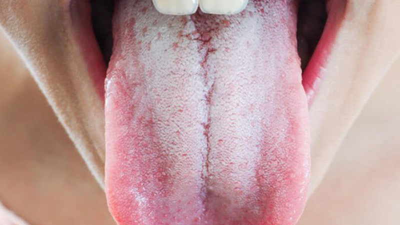 Nhìn lưỡi đoán bệnh thông qua màu sắc và bệnh lý cơ bản 2