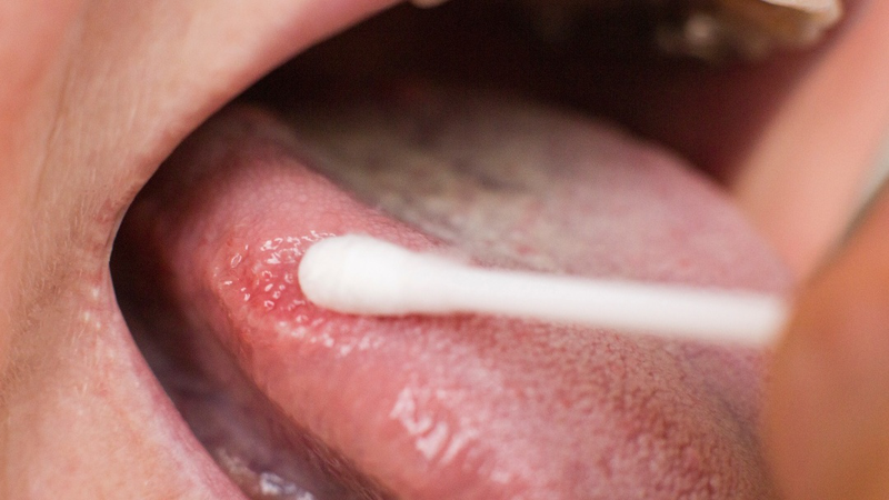 Nhìn lưỡi đoán bệnh thông qua màu sắc và bệnh lý cơ bản 3