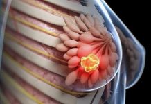 8 kiểu phụ nữ dễ bị K vú nhất: Xem bạn có trong số đó?