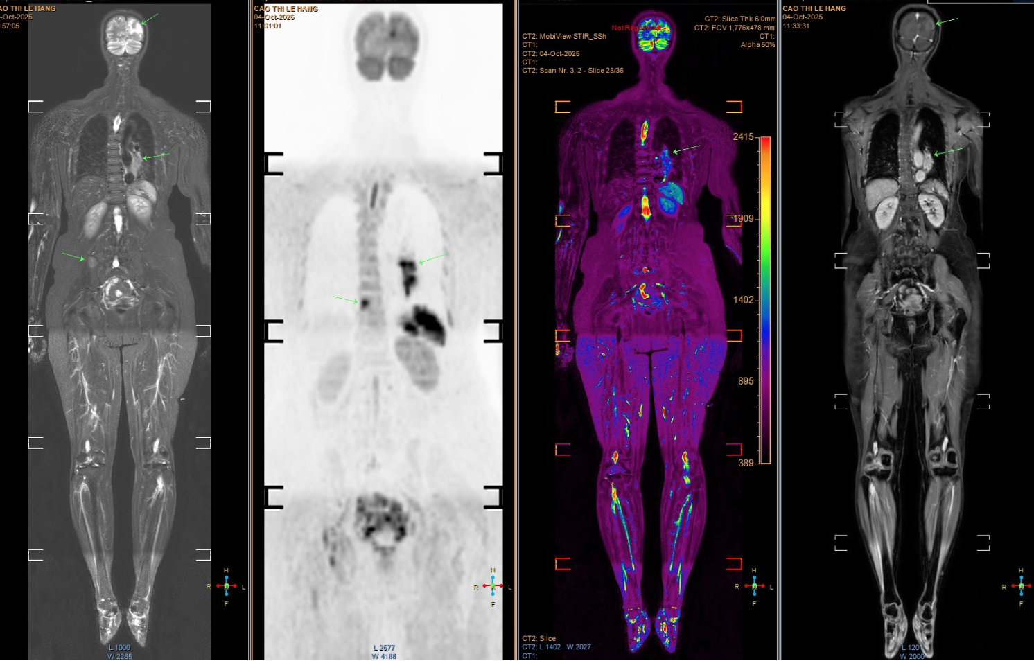 Mắc ung thư giai đoạn cuối di căn não, người phụ nữ đi khám, òa khóc khi biết “thủ phạm” đến từ chồng con- Ảnh 1.