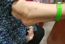 Bất kể nam hay nữ, nếu gặp phải 4 triệu chứng này ở cánh tay, rất có thể bạn bị ung thư: Dấu hiệu thứ 3 bị bỏ qua nhiều nhất