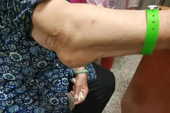 Bất kể nam hay nữ, nếu gặp phải 4 triệu chứng này ở cánh tay, rất có thể bạn bị ung thư: Dấu hiệu thứ 3 bị bỏ qua nhiều nhất