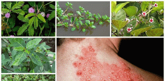 6 mẹo dân gian giúp điều trị bệnh Zona thần kinh tại nhà hiệu quả.