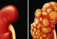 Những dấu hiệu âm thầm của u-ng thư thận dễ bị bỏ qua