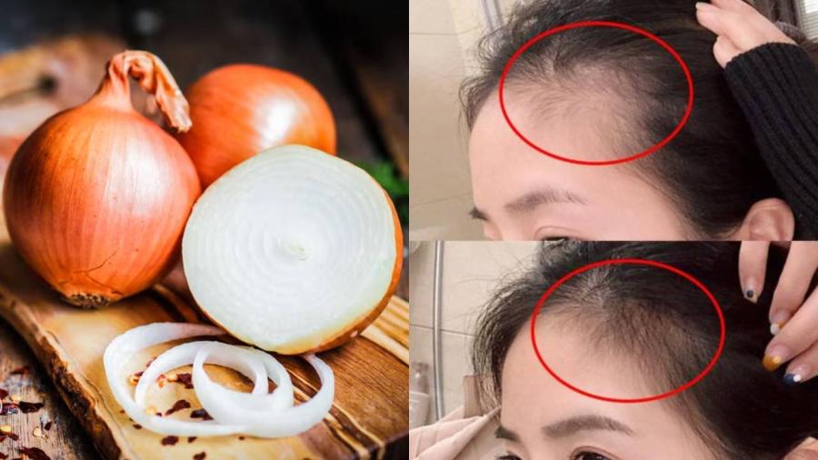 Hành tây có chứa nhiều dưỡng chất giúp kích thích mọc tóc, nuôi dưỡng mái tóc chắc khỏe.