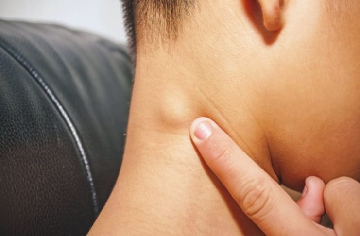 5 dấu hiệu dễ nhận biết nhất của ungthư tuyến giáp