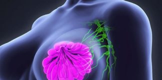 5 dấu hiệu ungthư vú dễ nhận biết nhưng nhiều người bỏ qua: Cẩn thận di căn xa