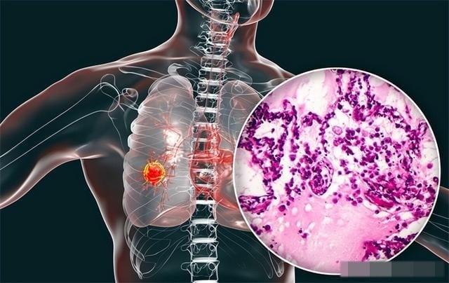 Trước hết, cần phải làm rõ rằng các vấn đề về phổi không xuất phát từ một nguyên nhân đơn lẻ, mà là kết quả của quá trình tích lũy lâu dài từ nhiều yếu tố khác nhau. 